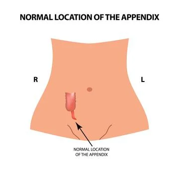 The normal location of the appendix. Vector illustration on isolated background. Stock Illustration