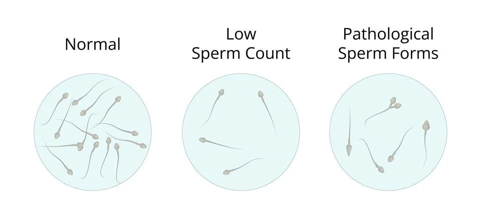 Normal, low and pathological sperm count showing different sperm forms Stock Illustration