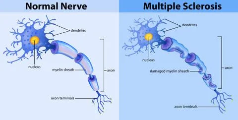 Normal nerve and multiple sclerosis Stock Illustration