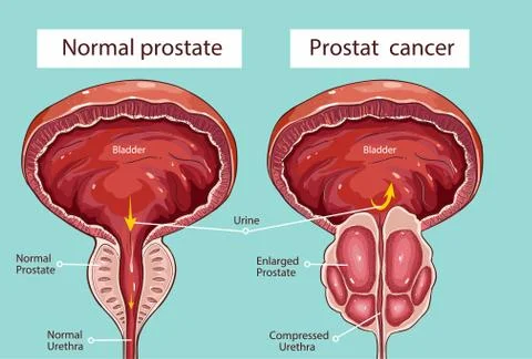 Normal prostate and acute prostatitis. Medical illustration Stock Illustration