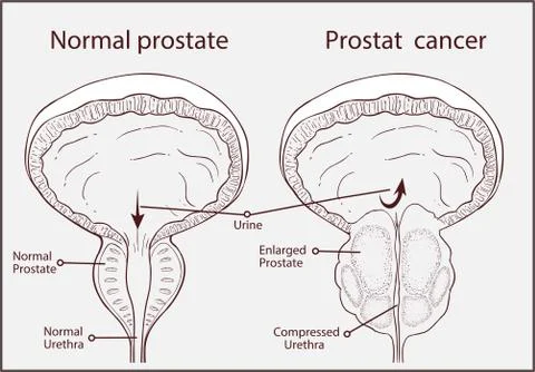 Normal prostate and acute prostatitis. Medical illustration Stock Illustration