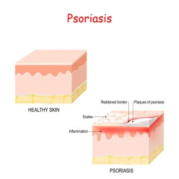 Normal skin and psoriasis. Stock Illustration