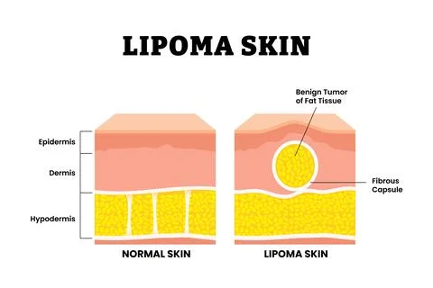 Normal vs Lipoma skin structure anatomy cross section. Benign tumor of fat .. Stock Illustration