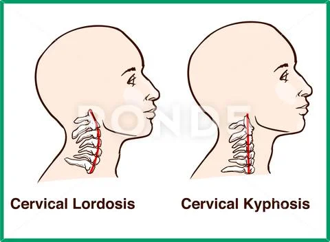 Normal vs. Reversal of Cervical Lordosis: Graphic #135662665