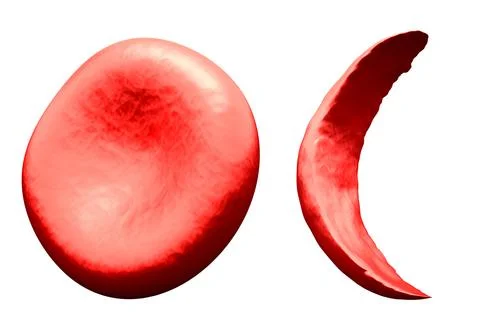 Normal vs Sickle Red Blood Cell 스톡 일러스트