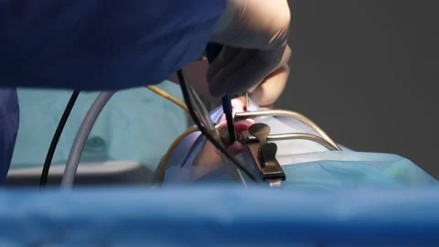 Nose surgery for a small patient Stock Footage 165182501