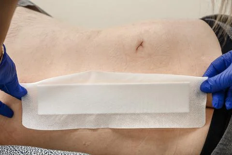 Nurse hand patching mole removal surgery incision as epidermal birthmark conc Stock Photos