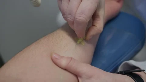 Nurse Inserting Needle Into Patient Arm During Medical Treatment Stock Footage 337913432