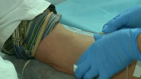 Nurse Inserts Needle Into Arm Of Blood Donor Stock Footage 58722248
