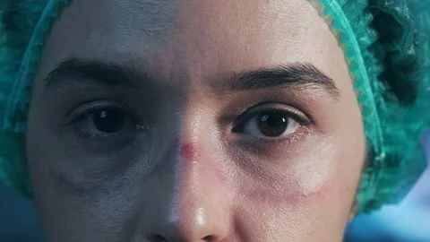 Nurse shows the wounds rubbed with protective mask after shift in hospital Stock Footage 144986531