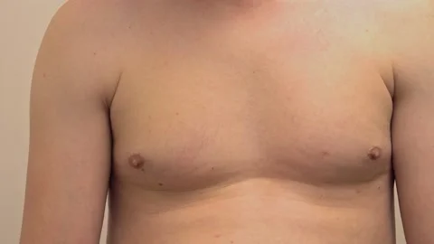 Obese male breasts. Overweight problems Stock Footage 147667880