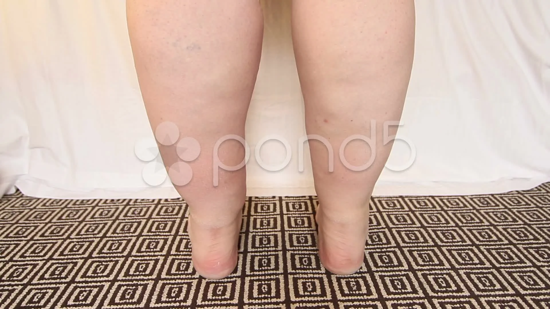 Obese man with dropsy on leg