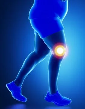 Obesity knee problem Illustrazione stock