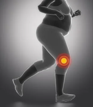Obesity knee problem Illustrazione stock
