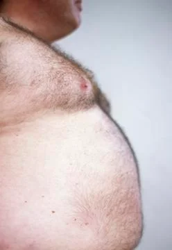 Obesity Stock-Fotos