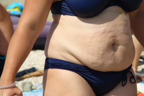 Obesity 스톡 사진
