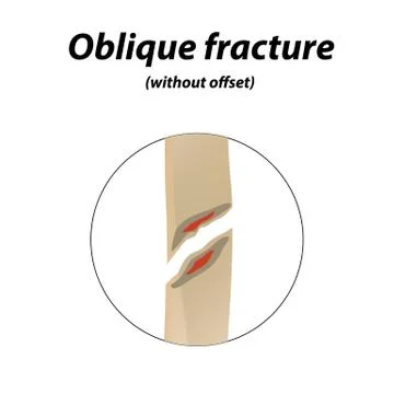 Oblique, without offset bone fracture. Infographics. Vector illustration on a Stock Illustration