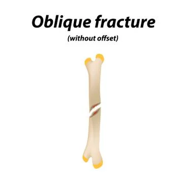 Oblique, without offset bone fracture. Infographics. Vector illustration on a Illustrazione stock