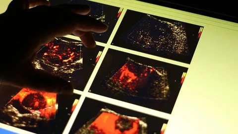 ODESA, UKRAINE - 1/10/2019: Analyzing of Liver on Touch Screen Display. Stock Footage 100599787