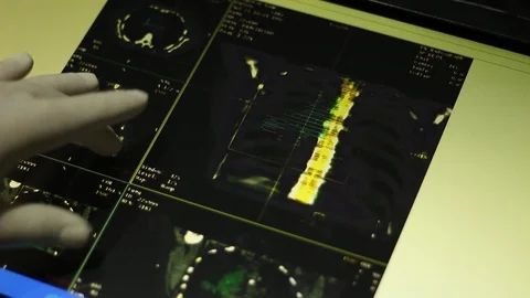 ODESA, UKRAINE - 1/10/2019: Analyzing of Spinal Cord on Touch Screen Display. Stock Footage 100599102