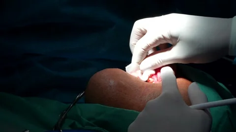 Odontologist cutting stitching thread and his assistant stops bleeding during Stock Footage 299218625