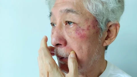 Old Asian Man Touching His Face with Visible Skin Rash or Bruise and Facial Hair Vídeos de archivo 346703643