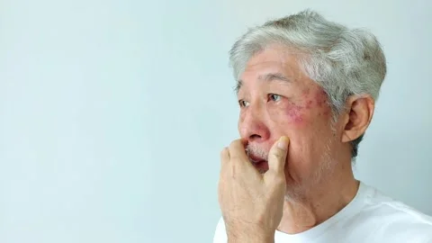 Old Asian Man Touching His Face with Visible Skin Rash or Bruise and Facial Hair Vídeos de archivo 346751065