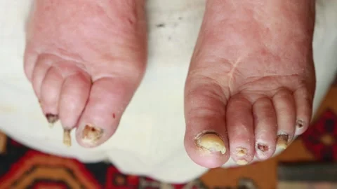Old toenails of an old man. Stratified nails, fungus and onychomycosis, close-up Stockbeeldmateriaal 253470507