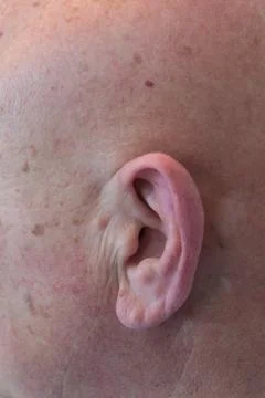 Older man close view of ear with no hair, bald, alopecia, chemotherapy Stock Photos