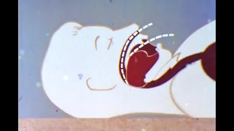 Older methods of dealing with an asphyxiating person are considered obsolete Stock Footage 118403659