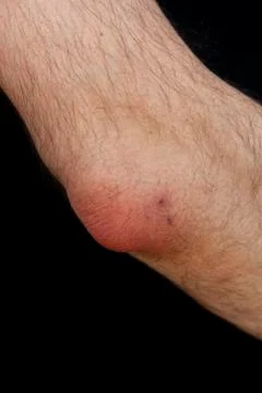 Olecranon bursitis, also known as students elbow, is a medical condition ca Stock Photos