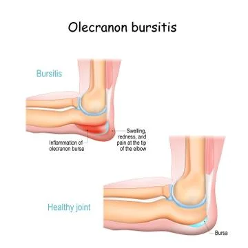 Olecranon bursitis. student elbow Stock Illustration