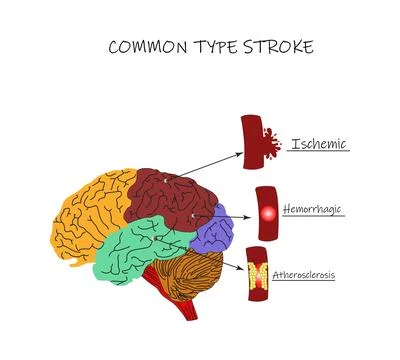 One common type of brain Stroke is characterized Stock Illustration