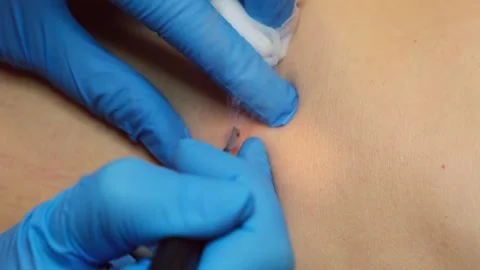 One day surgical procedure - removing papilloma or keratoma. Stock-Footage 249132838