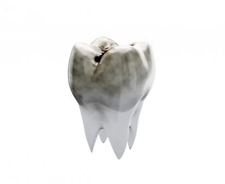 One dirty molar tooth, tooth decay, caries Stock Illustration