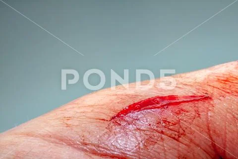 One photo of a series of photos taken of a fresh bleeding cut development over a Stock Photos
