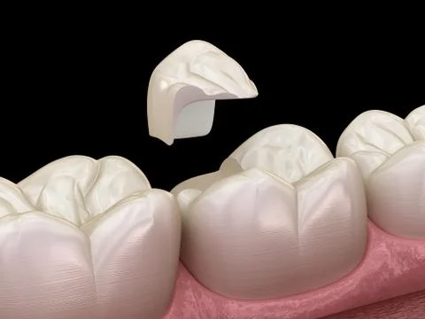 Onlay ceramic crown fixation over tooth. Medically accurate 3D illustration o Stock Illustration