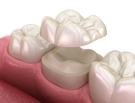 Onlay ceramic crown fixation over molar tooth. Illustrazione stock