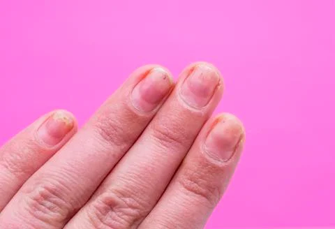Onycholysis. Disease of nails, caused by the use of shellac or gel-varnish. Stock Photos