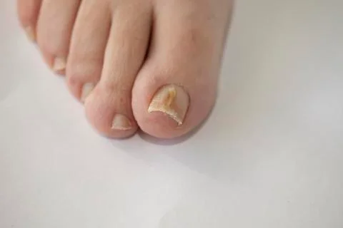 Onychomycosis Stock Photos