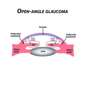 Open-angle glaucoma. A common type of glaucoma. The anatomical structure of the Stock Illustration