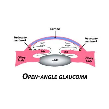 Open-angle glaucoma. A common type of glaucoma. The anatomical structure of the Stock Illustration