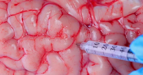real brain surgery pictures