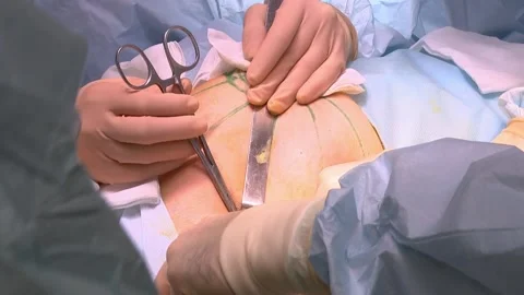 Open breast surgery for malignancy. Close-up of doctors hands and tools. Stock Footage 152091523