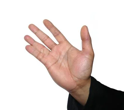 An open hand isolated on a white background, presents a congenital deformit.. Stock Photos