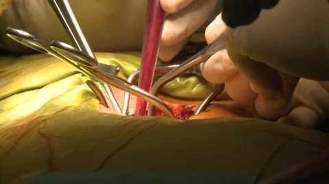 Open hear surgery Stock Footage 39307598
