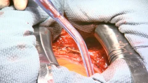 Open Heart Surgery Close-Up With Suctioning Stock Footage 20959118
