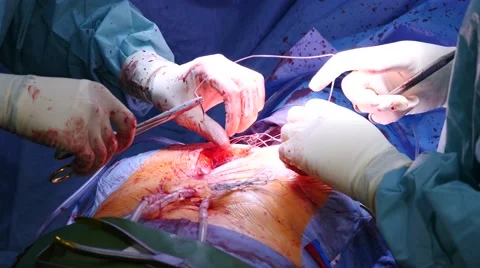 Open heart surgery, close-up of surgeons closing rib cage Stock Footage 55756951