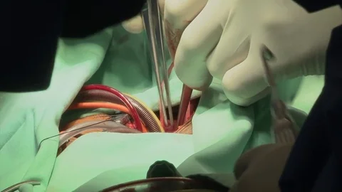 Open heart surgery Stockbeeldmateriaal 81740050