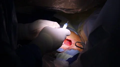 Open heart surgery Stockbeeldmateriaal 197446039